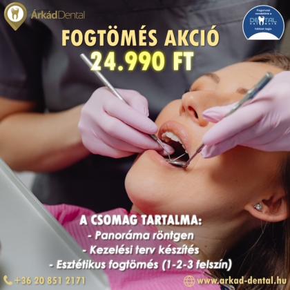 Fogtömés Akció Fogtömés Akció