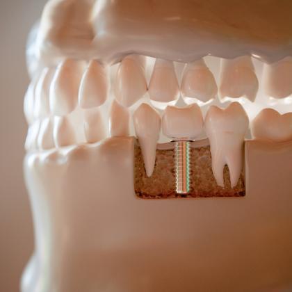 Fogbeültetés menete – így zajlik a modern implantációs kezelés az Árkád Dentalban Fogbeültetés menete – így zajlik a modern implantációs kezelés az Árkád Dentalban
