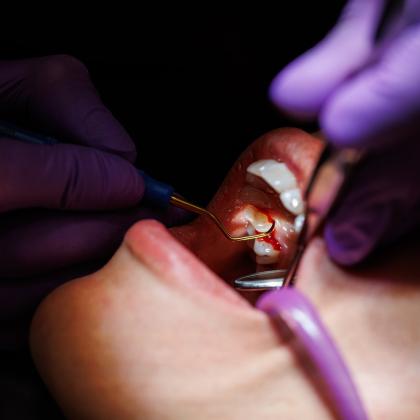 Szájsebészet: modern, fájdalommentes megoldások az Árkád Dentalnál