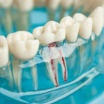 Gyökérkezelés Budapest szívében: fájdalommentes megoldás az Árkád Dentalnál