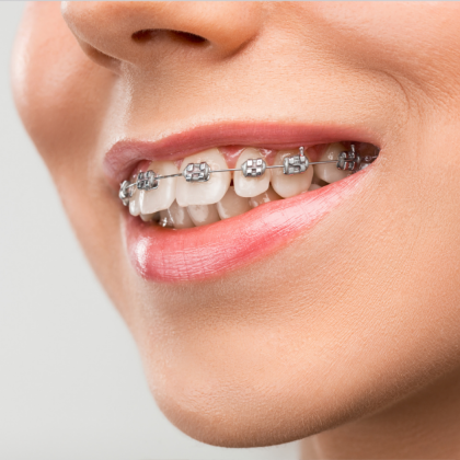 Fogszabályozás menete lépésről lépésre - Árkád Dental