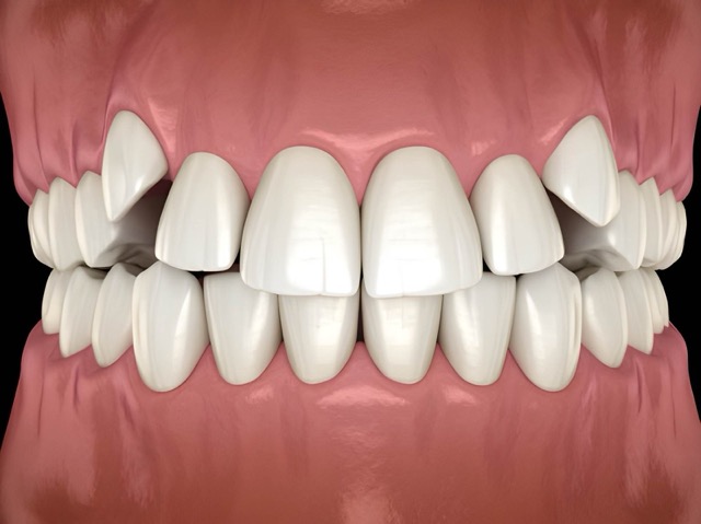 kiálló fogak - Árkád Dental