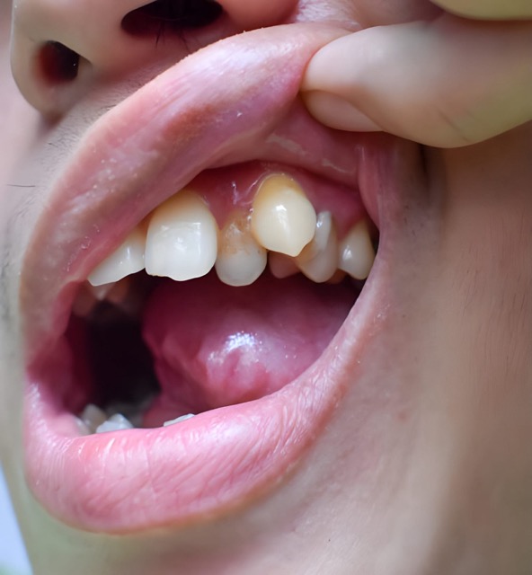 kiálló szemfog - Árkád Dental