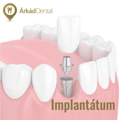 Implantológia - fogpótlás